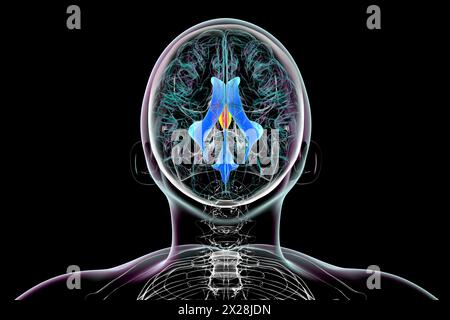 Agrandissement du troisième ventricule cérébral, illustration Banque D'Images