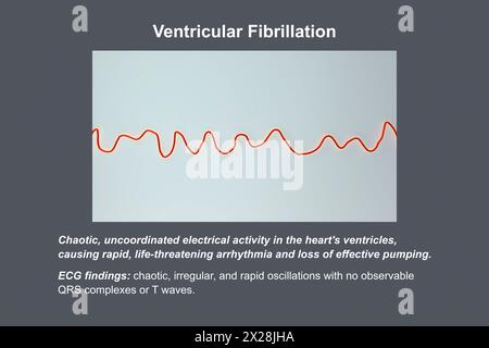 ECG en cas de fibrillation ventriculaire, illustration Banque D'Images