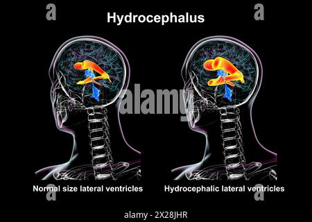 Ventricules latéraux dilatés et normaux, illustration Banque D'Images
