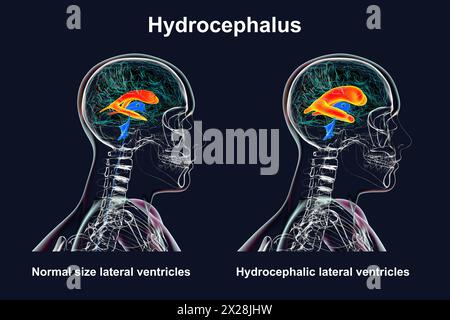 Ventricules latéraux dilatés et normaux, illustration Banque D'Images