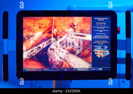 Ecran avec image interne d'une intervention chirurgicale, traitement chirurgical du cancer de la prostate, prostatectomie radicale, robot chirurgical Da Vinci, Urologie, Banque D'Images