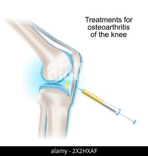 Traitements de l'arthrose du genou. Seringue et injection intra-articulaire. Illustration vectorielle. Illustration de Vecteur