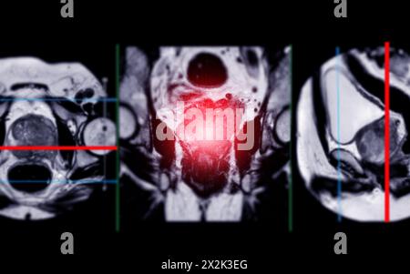 L'IRM de la glande prostatique révèle une lésion focale d'intensité de signal anormale (IS) au niveau des zones périphériques postéro-latérales gauches à l'apex, ce qui contribue à la dia Banque D'Images