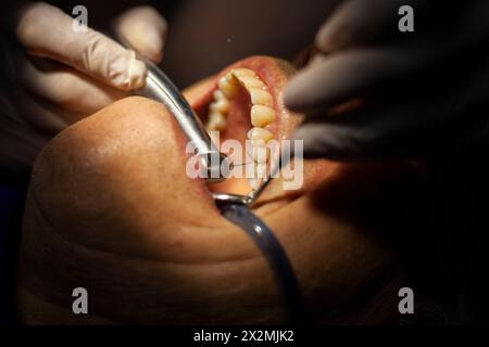 un homme adulte est vu par un dentiste, qui effectue une procédure avec une perceuse pour réparer une cavité dans une dent molaire. Banque D'Images
