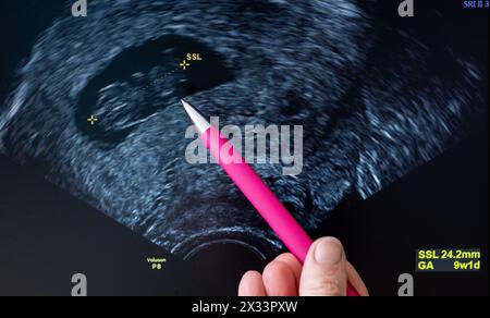 Bitterfeld Wolfen, Allemagne. 24 avril 2024. Un gynécologue pointe la tête d'un fœtus à l'échographie, dont la longueur couronne-croupe (SSL) de 24,2 mm indique une période de gestation d'environ 9 semaines. L'avortement n'est pas punissable s'il est pratiqué dans les douze premières semaines de grossesse, si la personne enceinte a déjà bénéficié d'une consultation approuvée par l'État et si au moins trois jours se sont écoulés depuis cette consultation. (To dpa 'Number of avortions has Risen') crédit : Hendrik Schmidt/dpa/Alamy Live News Banque D'Images