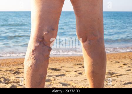 femme en mer avec des jambes douloureuses, des bosses sur ses tibias, thrombophlébite des veines des membres inférieurs. Banque D'Images