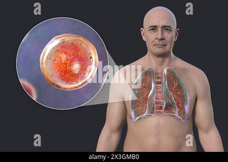 Illustration d'un homme atteint d'adiaspiromycose pulmonaire, une infection respiratoire causée par le champignon Emmonsia spp, caractérisée par la présence de spores fongiques encapsulées agrandies dans les tissus pulmonaires. Banque D'Images