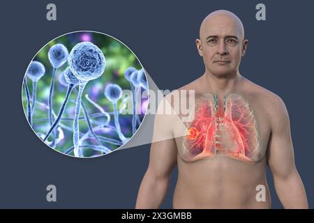 Illustration d'un homme présentant une lésion de mucormycose pulmonaire et vue rapprochée des champignons Mucor, un des agents étiologiques de la mucormycose pulmonaire. Banque D'Images