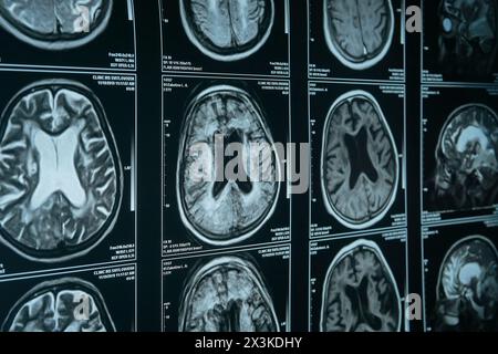 Image IRM du cerveau en gros plan. Diagnostic et traitement des maladies cérébrales. Banque D'Images