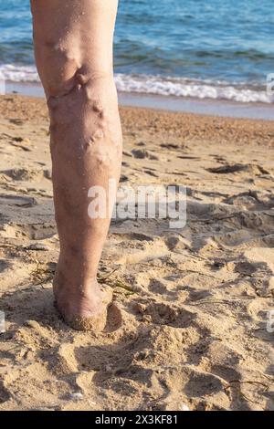 jambe d'une femme âgée avec des problèmes de veines. Thrombophlébite des vaisseaux des membres inférieurs. Banque D'Images