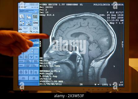 Tumeur cérébrale, IRM (imagerie par résonance magnétique), imagerie médicale pour le diagnostic. Hôpital Policlinica Gipuzkoa, Saint-Sébastien, Donostia, Euskadi, Espagne Banque D'Images