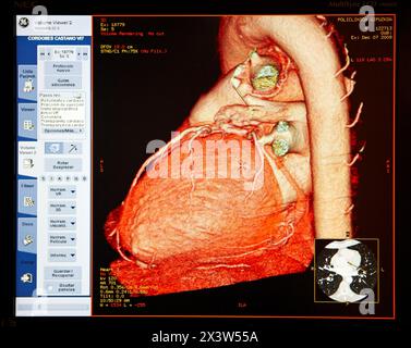 Cœur, arcade de l'aorte et artères coronaires, tomographie assistée par ordinateur (CAT), radiologie, imagerie médicale pour le diagnostic. Hôpital Policlini Banque D'Images