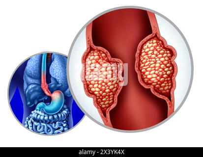 Cancer de l'œsophage ou carcinome de l'œsophage comme adénocarcinome mutant la croissance des cellules à l'intérieur du système digestif comme une tumeur croissante de gros plan. Banque D'Images