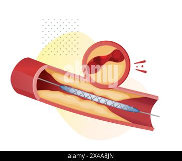 Stades d'athérosclérose - accumulation de plaque de cholestérol - illustration stock en tant que fichier EPS 10 Illustration de Vecteur