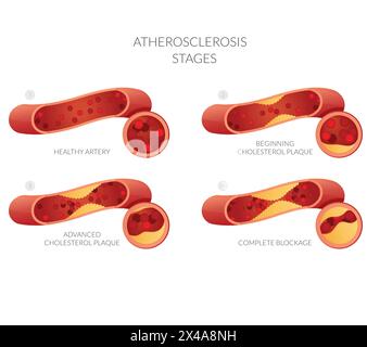 Stades d'athérosclérose - accumulation de plaque de cholestérol - illustration stock en tant que fichier EPS 10 Illustration de Vecteur