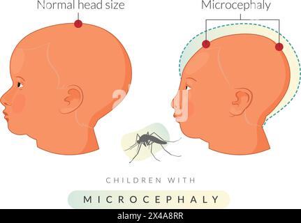 Enfants atteints de microcéphalie - virus Zika - illustration en tant que fichier EPS 10 Illustration de Vecteur