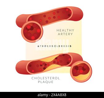 Athérosclérose - accumulation de plaque - illustration de stock en tant que fichier EPS 10 Illustration de Vecteur