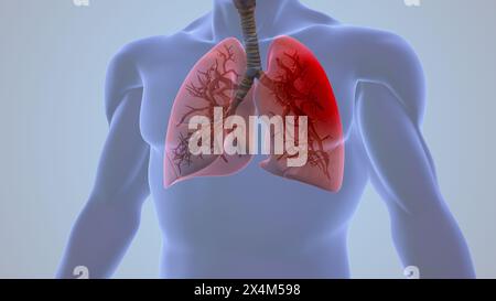 Douleur inflammatoire pulmonaire pleurésie humaine Banque D'Images