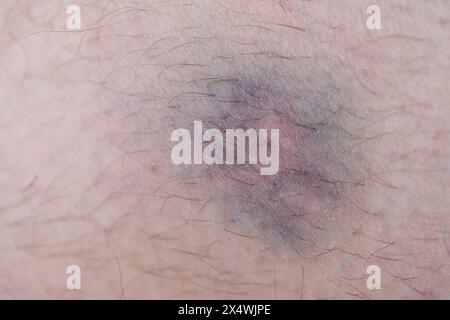 ecchymoses et ecchymoses sur les jambes de l'homme Banque D'Images