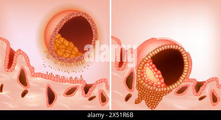 Le processus au cours de l'implantation embryonnaire. Le blastocyste s'implante dans l'endomètre maternel. Apposition et adhésion blastocystes Illustration de Vecteur