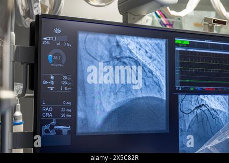 Denizli Turquie-28 février 2024 ; les médecins effectuent une opération diagnostique.coronarographie.intervention coronarienne percutanée-recanalisation, ballon angi Banque D'Images