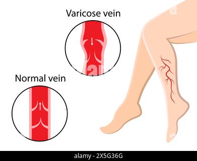 Varices. Douleur dans les jambes. Anatomie humaine Illustration de Vecteur