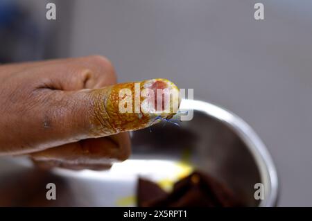 un pouce de la main gauche avec ablation chirurgicale de l'ongle du pouce, et des points de suture d'une plaie coupée après un traumatisme direct au doigt qui a causé des dommages o Banque D'Images