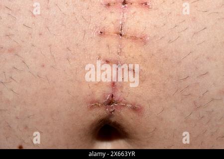 Suture chirurgicale cicatrisante après ablation d'une hernie ombilicale sur l'abdomen d'un homme, gros plan. Banque D'Images