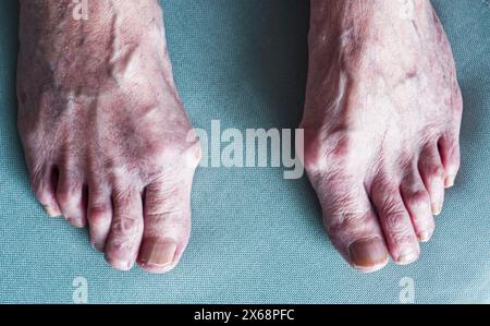 Oignons, hallux valgus, sur les pieds d'une femme âgée. Banque D'Images