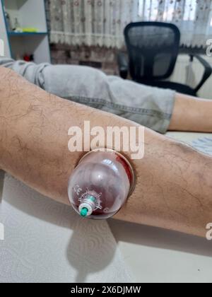 La thérapie des sangsues sur les jambes est une méthode utilisée en médecine traditionnelle. Banque D'Images