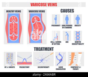 Affiche médicale des causes variqueuses et du traitement Illustration de Vecteur