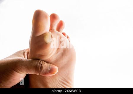 Peau sèche, cal plantaire et écailles sur le pouce sur fond blanc. Image à des fins médicales. Banque D'Images