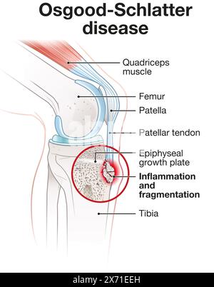 La maladie d'Osgood-Schlatter provoque des douleurs au genou et un gonflement au niveau de la tubérosité tibiale, souvent chez les adolescents en raison de la croissance rapide et de l'activité physique. Banque D'Images