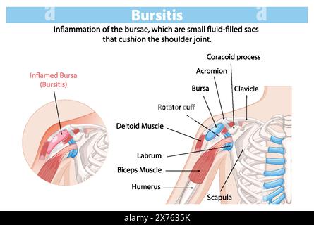 Anatomie détaillée de l'inflammation de la bursite de l'épaule Illustration de Vecteur