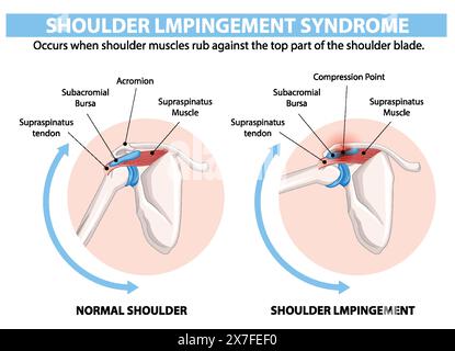 Comparaison de l'épaule normale et de l'impact de l'épaule Illustration de Vecteur