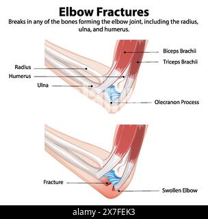 Schéma montrant les types de fractures du coude Illustration de Vecteur