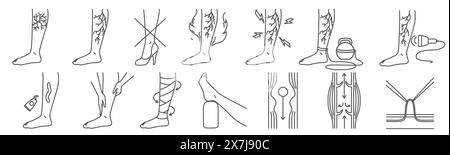 Symptôme de maladie variqueuse, infographie médicale de traitement Illustration de Vecteur