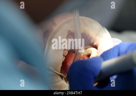 Dentiste avec assistant sous microscope traite les dents du patient. La dentisterie moderne progressive. Nettoyage professionnel des dents Banque D'Images