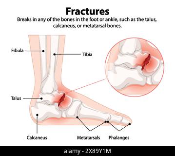 Illustration de fractures des os du pied et de la cheville Illustration de Vecteur