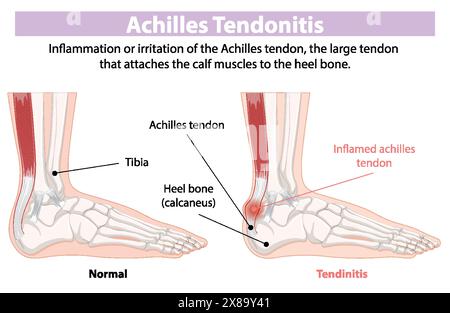 Comparaison du tendon d'Achille normal et enflammé Illustration de Vecteur