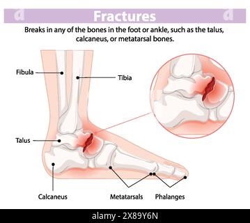 Illustration de fractures osseuses du pied et de la cheville Illustration de Vecteur