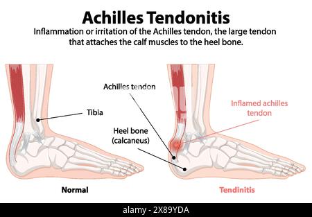 Comparaison du tendon d'Achille normal et enflammé Illustration de Vecteur