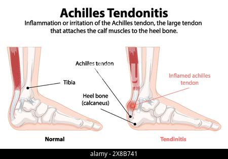 Comparaison du tendon d'Achille normal et enflammé Illustration de Vecteur