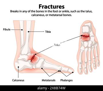 Illustration de fractures osseuses du pied et de la cheville Illustration de Vecteur