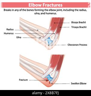 Schéma détaillé des fractures du coude Illustration de Vecteur
