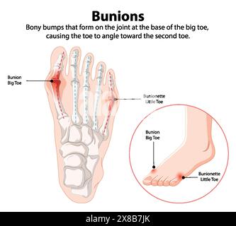 Diagramme montrant les oignons sur les os du pied Illustration de Vecteur