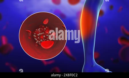 Concept de douleur des pieds périphériques avec caillot sanguin Banque D'Images