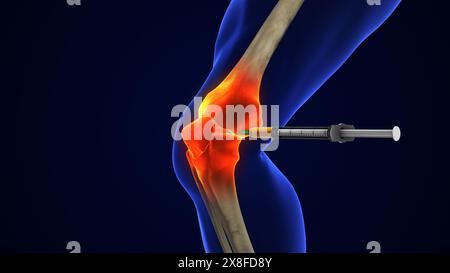 Anatomie traitement de l'articulation du genou humain, injection d'arthrose Banque D'Images