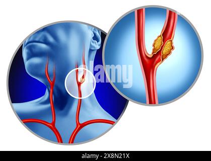 Maladie de l'artère carotide comme les artères amenant le flux sanguin au cerveau est interrompu par l'athérosclérose comme l'accumulation de plaque à l'intérieur du vaisseau bloqué cau Banque D'Images