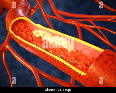 Flux de globules rouges dans un vaisseau sanguin gros plan. Une plaque de cholestérol sur la paroi d'un vaisseau sanguin. Rendu 3D. Banque D'Images